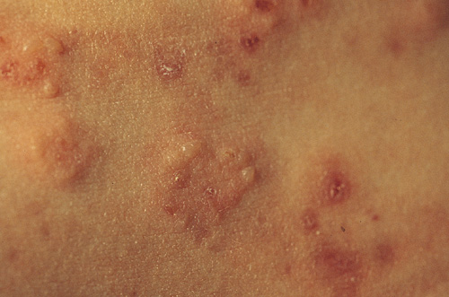 Dermatitis herpetiformis