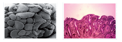 Coeliac Disease Damaged Intestine